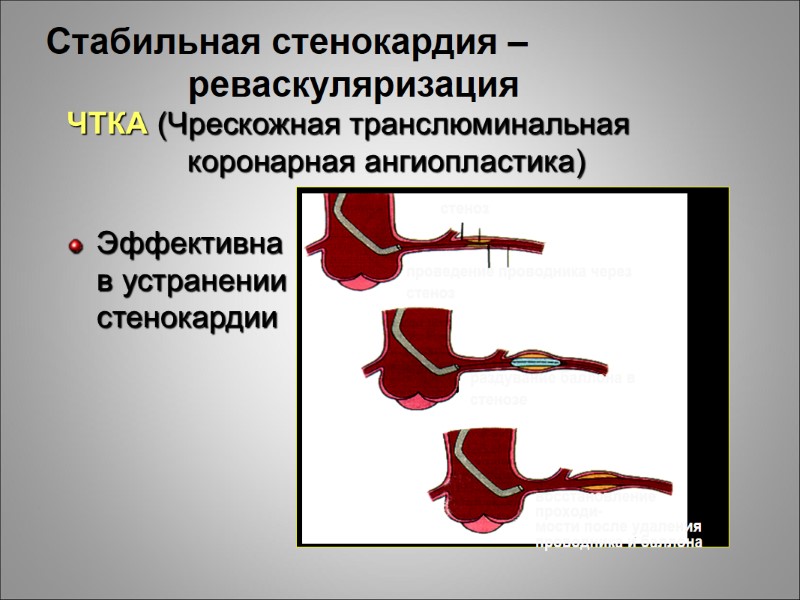 Стабильная стенокардия –  реваскуляризация ЧТКА (Чрескожная транслюминальная      